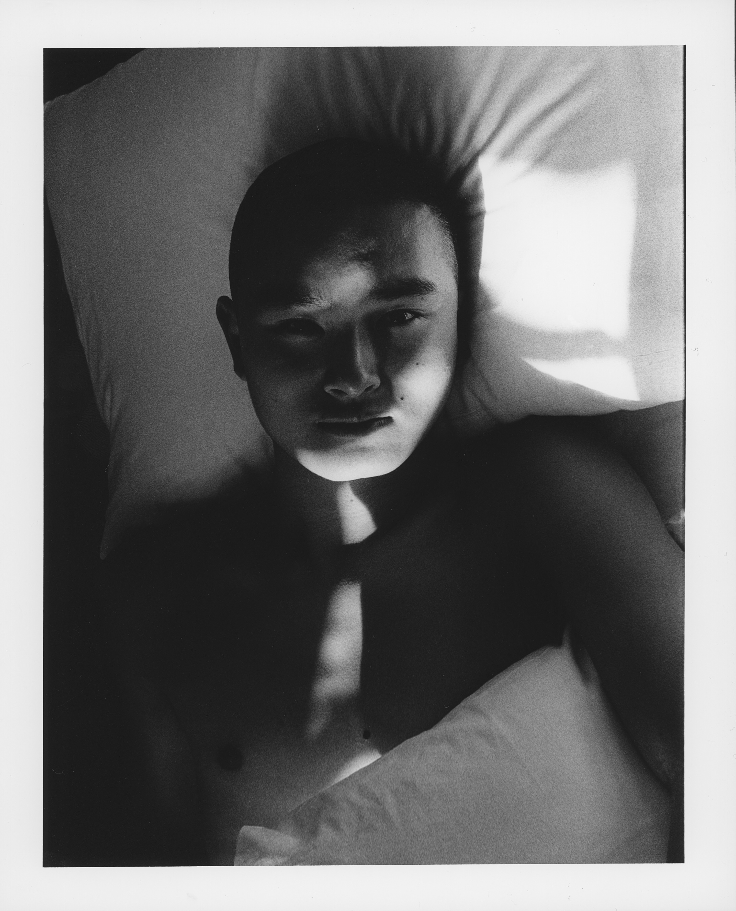 Black and white photograph of person with light beige skin and no hair, partially covered in white blankets, in a bed